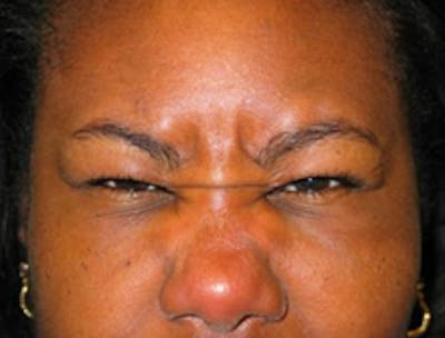 Botox Before & After Gallery - Patient 175169032 - Image 1