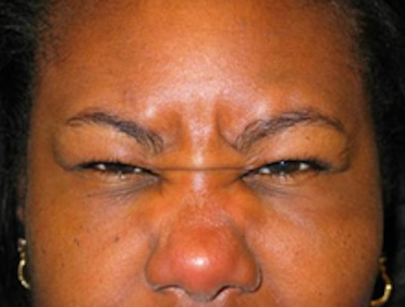 Botox Before & After Gallery - Patient 175169032 - Image 1