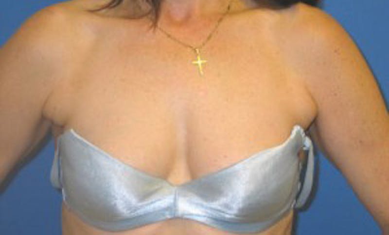 Liposuction Before & After Gallery - Patient 175169036 - Image 3