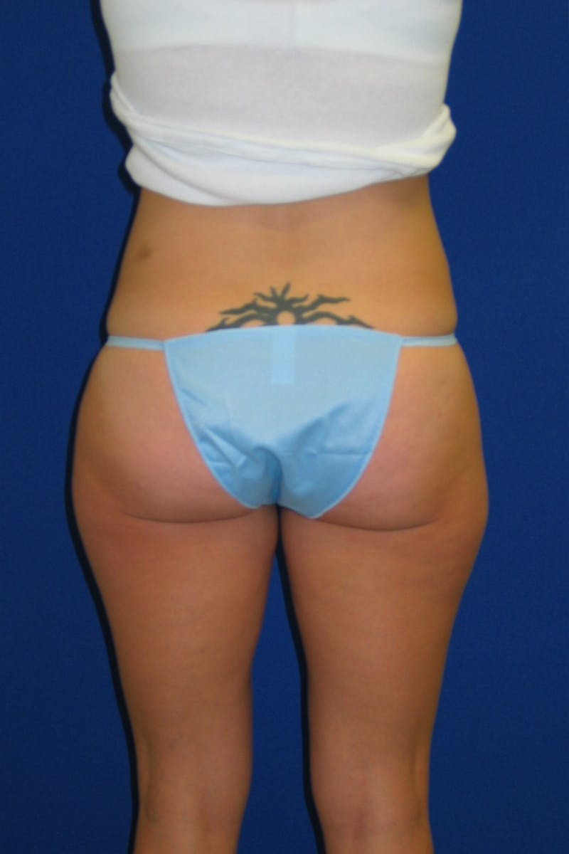 Mommy Makeover Before & After Gallery - Patient 175169039 - Image 7