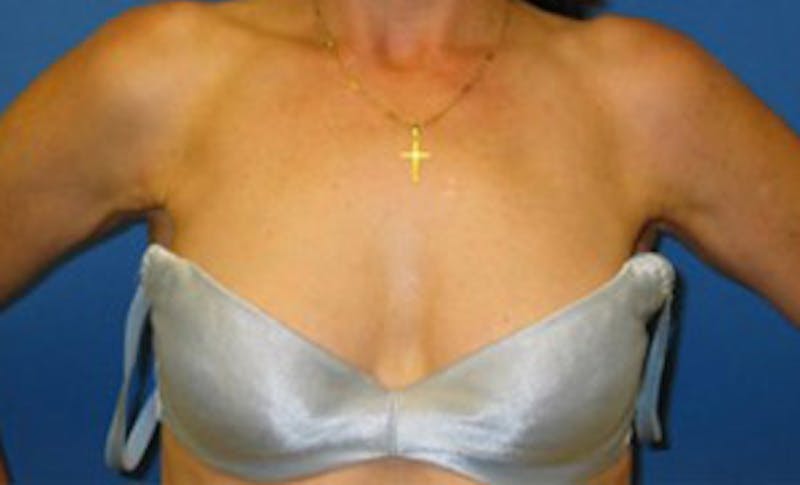Liposuction Before & After Gallery - Patient 175169036 - Image 4