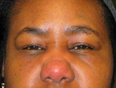 Botox Before & After Gallery - Patient 175169032 - Image 2