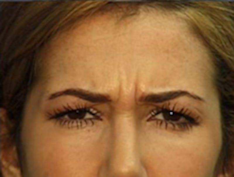 Botox Before & After Gallery - Patient 175169040 - Image 1