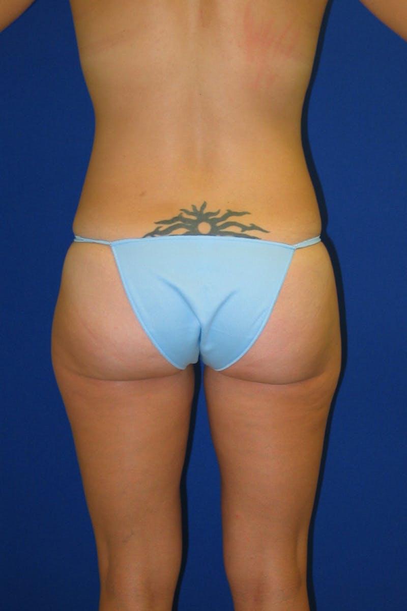 Mommy Makeover Before & After Gallery - Patient 175169039 - Image 8