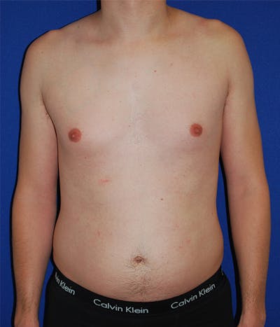 Liposuction Before & After Gallery - Patient 175169052 - Image 1