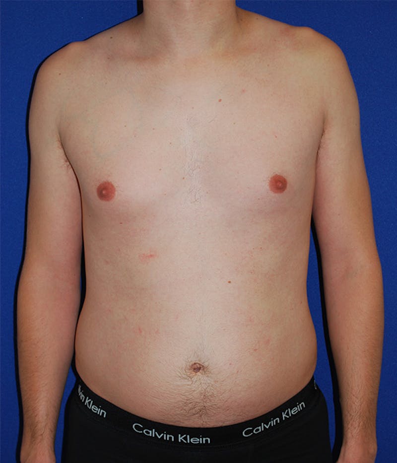 Liposuction Before & After Gallery - Patient 175169052 - Image 1