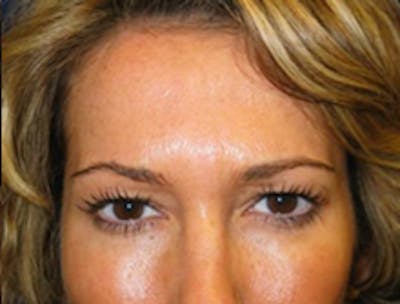 Botox Before & After Gallery - Patient 175169040 - Image 2