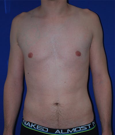Liposuction Before & After Gallery - Patient 175169052 - Image 2