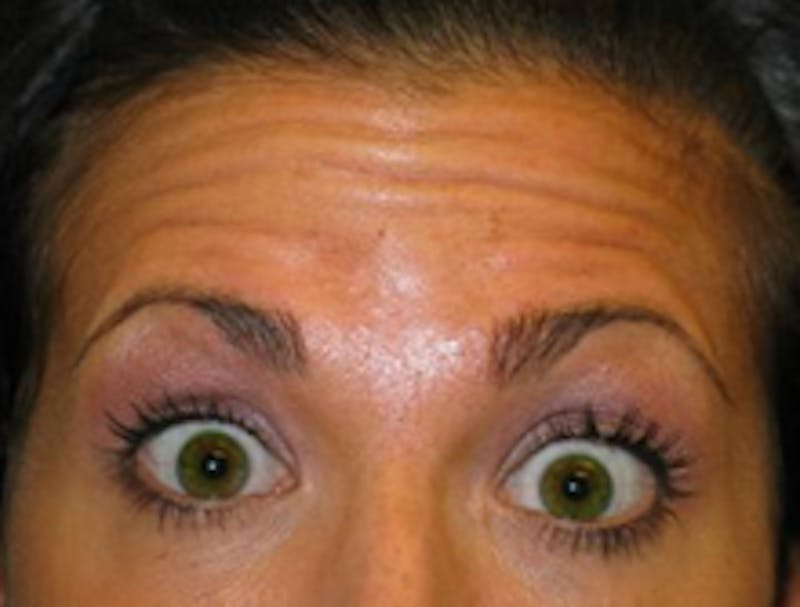 Botox Before & After Gallery - Patient 175169046 - Image 1