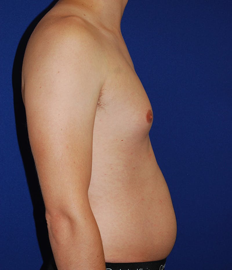 Liposuction Before & After Gallery - Patient 175169052 - Image 3