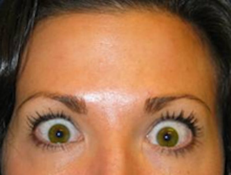 Botox Before & After Gallery - Patient 175169046 - Image 2