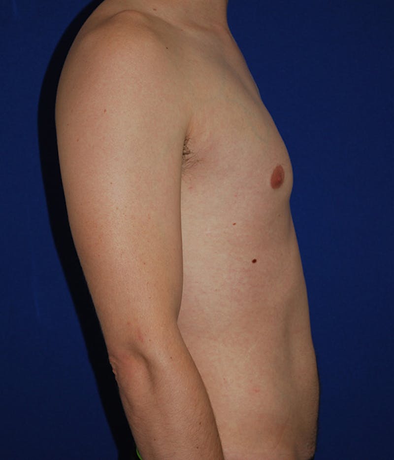 Liposuction Before & After Gallery - Patient 175169052 - Image 4