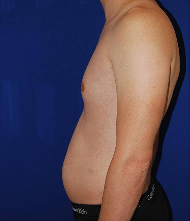 Liposuction Before & After Gallery - Patient 175169052 - Image 5