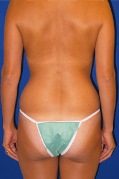 Brazilian Butt Lift Before & After Gallery - Patient 175169058 - Image 1