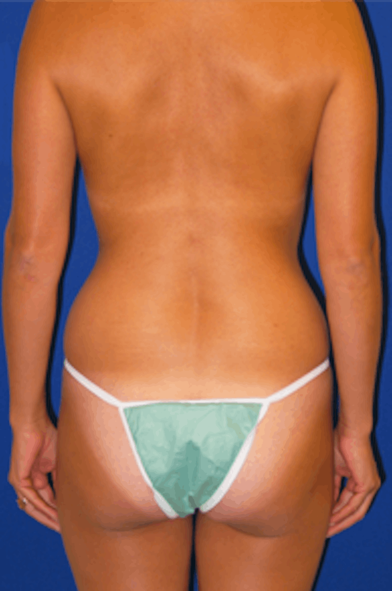 Brazilian Butt Lift Before & After Gallery - Patient 175169058 - Image 1