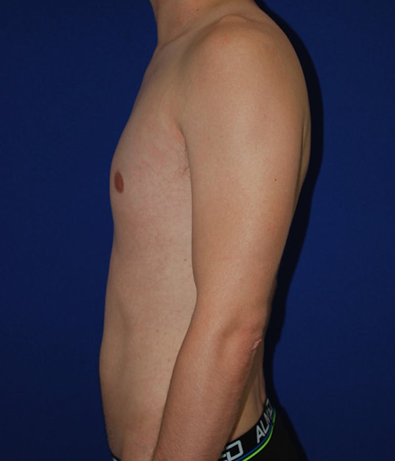 Liposuction Before & After Gallery - Patient 175169052 - Image 6