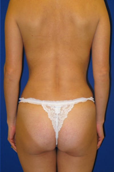 Brazilian Butt Lift Before & After Gallery - Patient 175169058 - Image 2