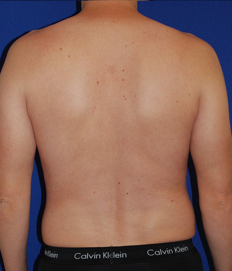 Liposuction Before & After Gallery - Patient 175169052 - Image 7