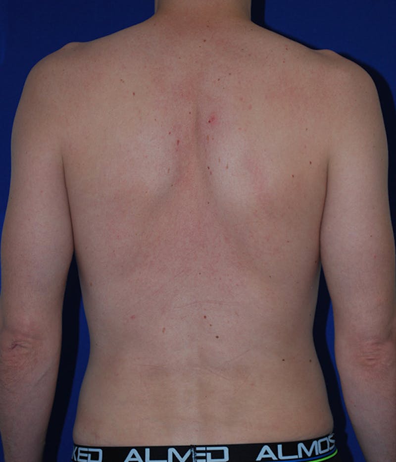 Liposuction Before & After Gallery - Patient 175169052 - Image 8