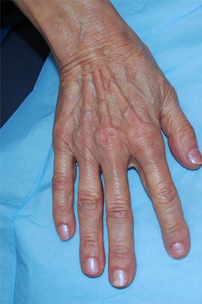 Injectable Fillers Before & After Gallery - Patient 137059 - Image 1