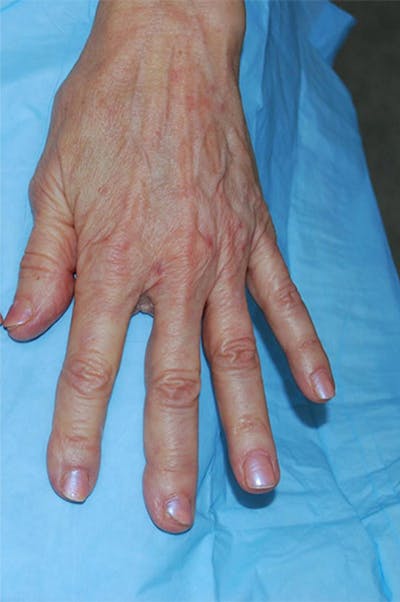 Injectable Fillers Before & After Gallery - Patient 137059 - Image 2