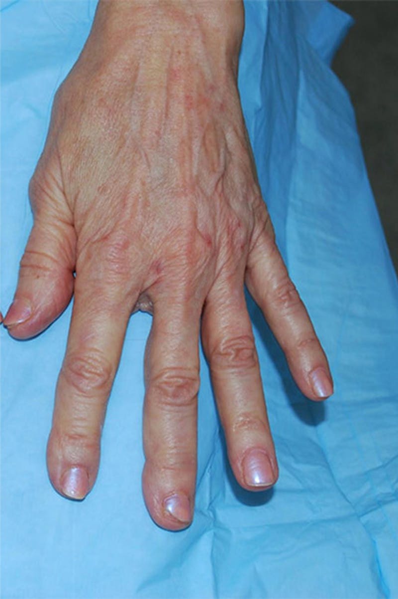 Injectable Fillers Before & After Gallery - Patient 137059 - Image 2