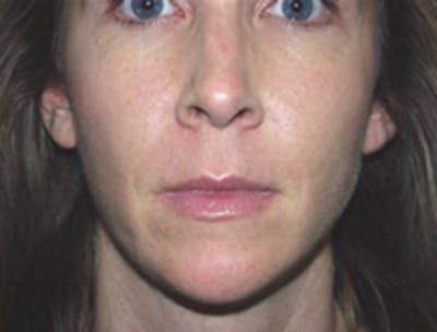 Injectable Fillers Before & After Gallery - Patient 175169066 - Image 1