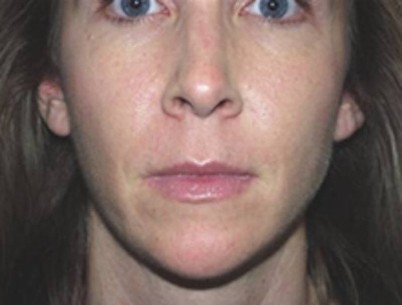 Injectable Fillers Before & After Gallery - Patient 175169066 - Image 1