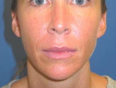 Injectable Fillers Before & After Gallery - Patient 175169066 - Image 2