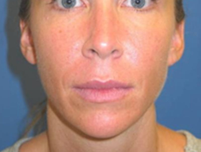 Injectable Fillers Before & After Gallery - Patient 175169066 - Image 2