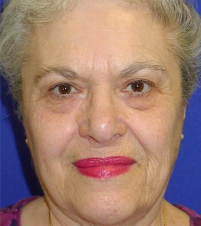 Blepharoplasty Before & After Gallery - Patient 175169081 - Image 1