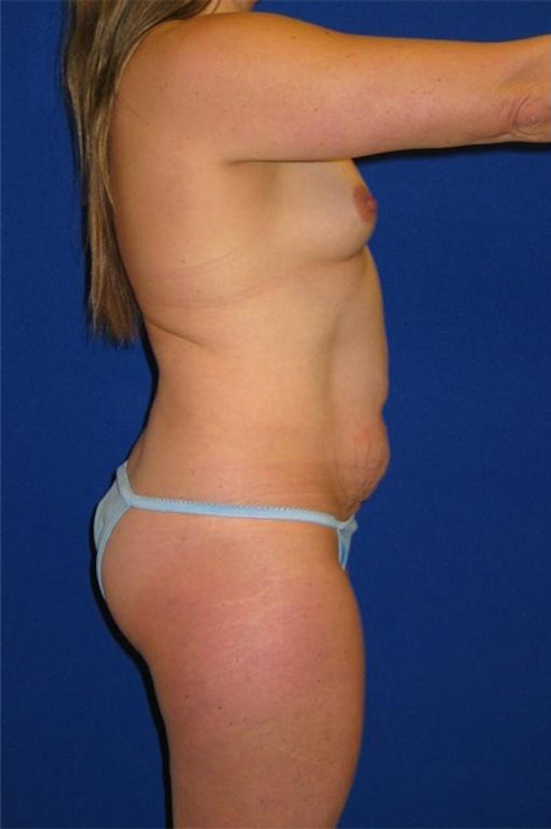 Liposuction Before & After Gallery - Patient 175169088 - Image 5