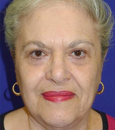 Blepharoplasty Before & After Gallery - Patient 175169081 - Image 2