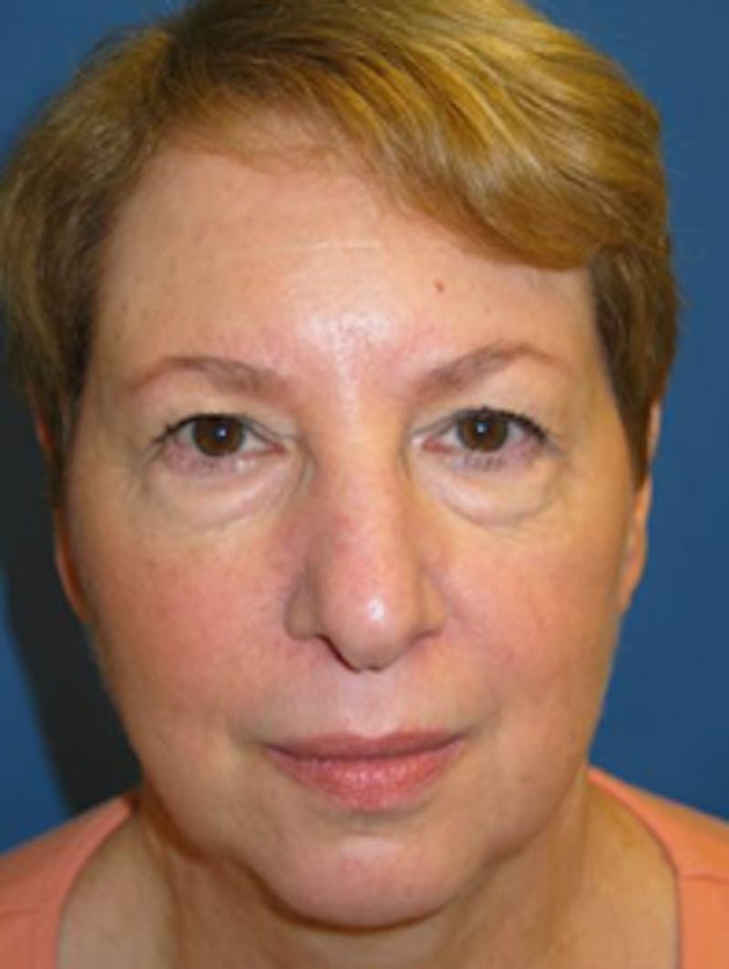 Blepharoplasty Before & After Gallery - Patient 175169096 - Image 1