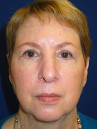 Blepharoplasty Before & After Gallery - Patient 175169096 - Image 2