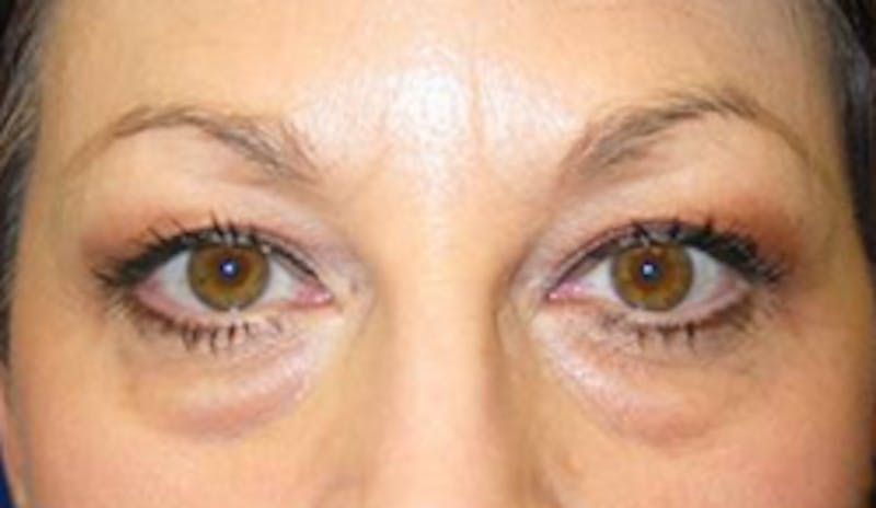 Blepharoplasty Before & After Gallery - Patient 175169099 - Image 1