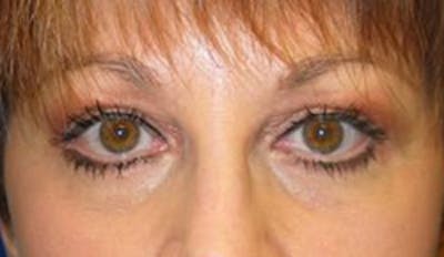 Blepharoplasty Before & After Gallery - Patient 175169099 - Image 2