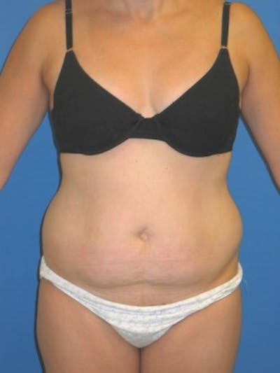 Mommy Makeover Before & After Gallery - Patient 175169112 - Image 1