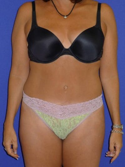 Mommy Makeover Before & After Gallery - Patient 175169112 - Image 2