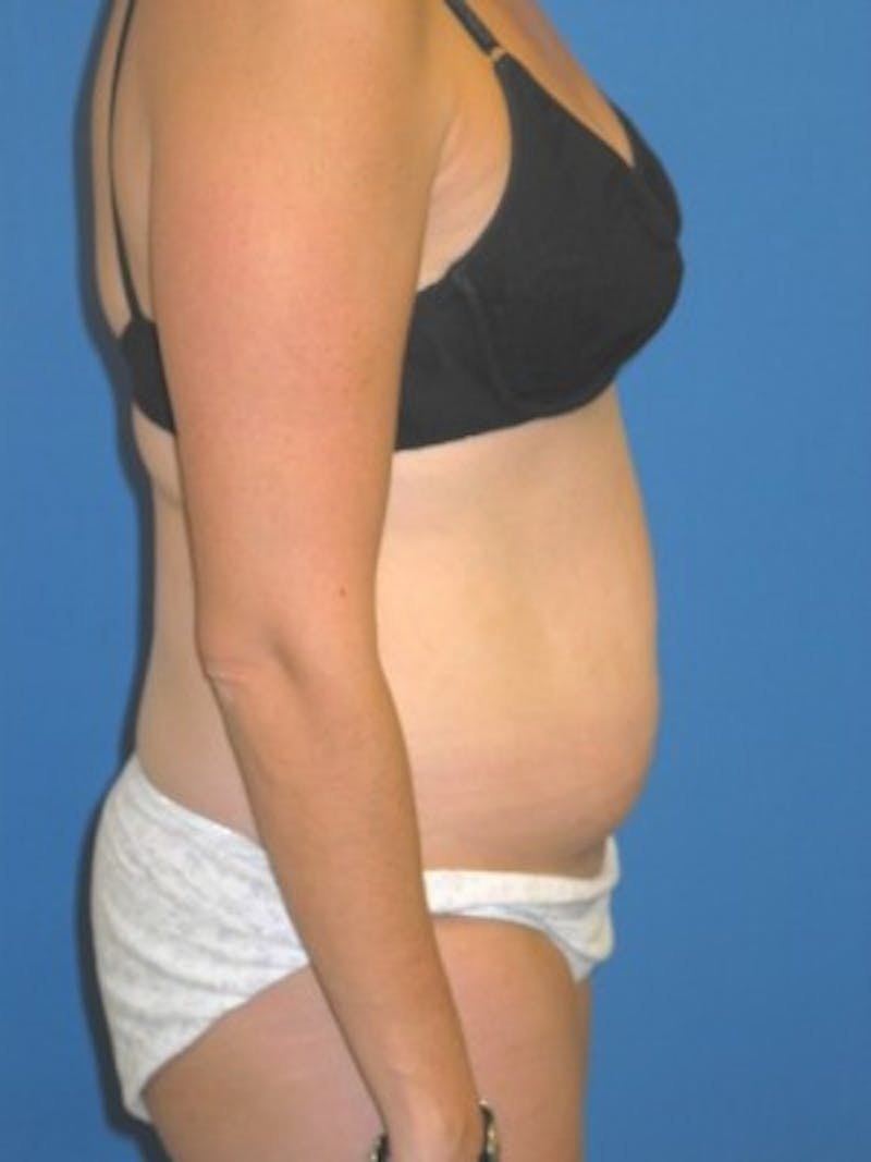 Mommy Makeover Before & After Gallery - Patient 175169112 - Image 3
