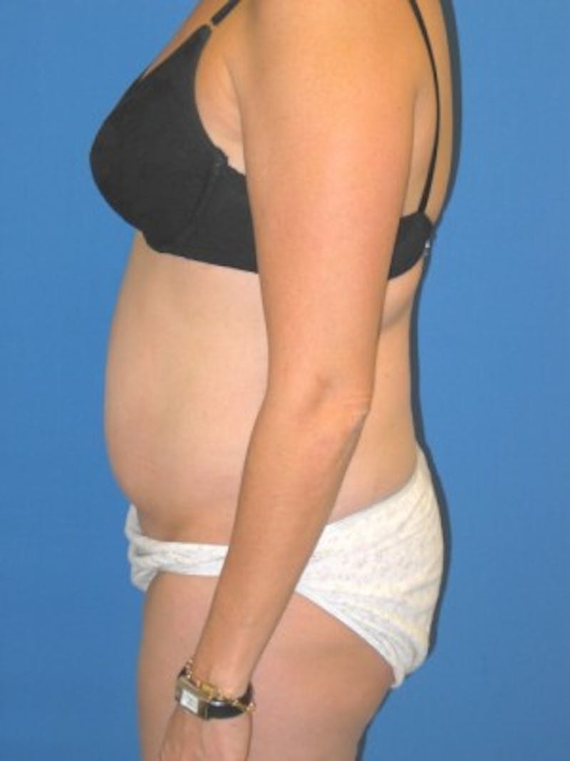 Mommy Makeover Before & After Gallery - Patient 175169112 - Image 5