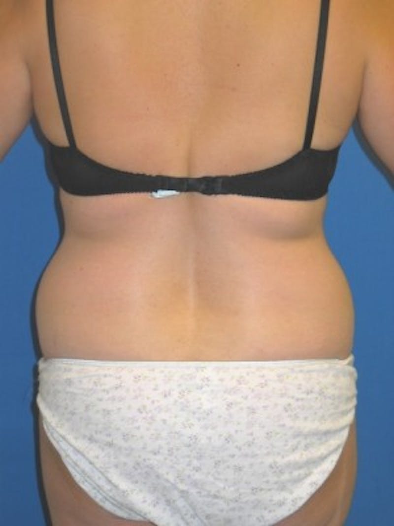 Mommy Makeover Before & After Gallery - Patient 175169112 - Image 7