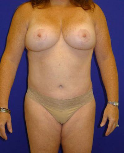 Mommy Makeover Before & After Gallery - Patient 175169121 - Image 2