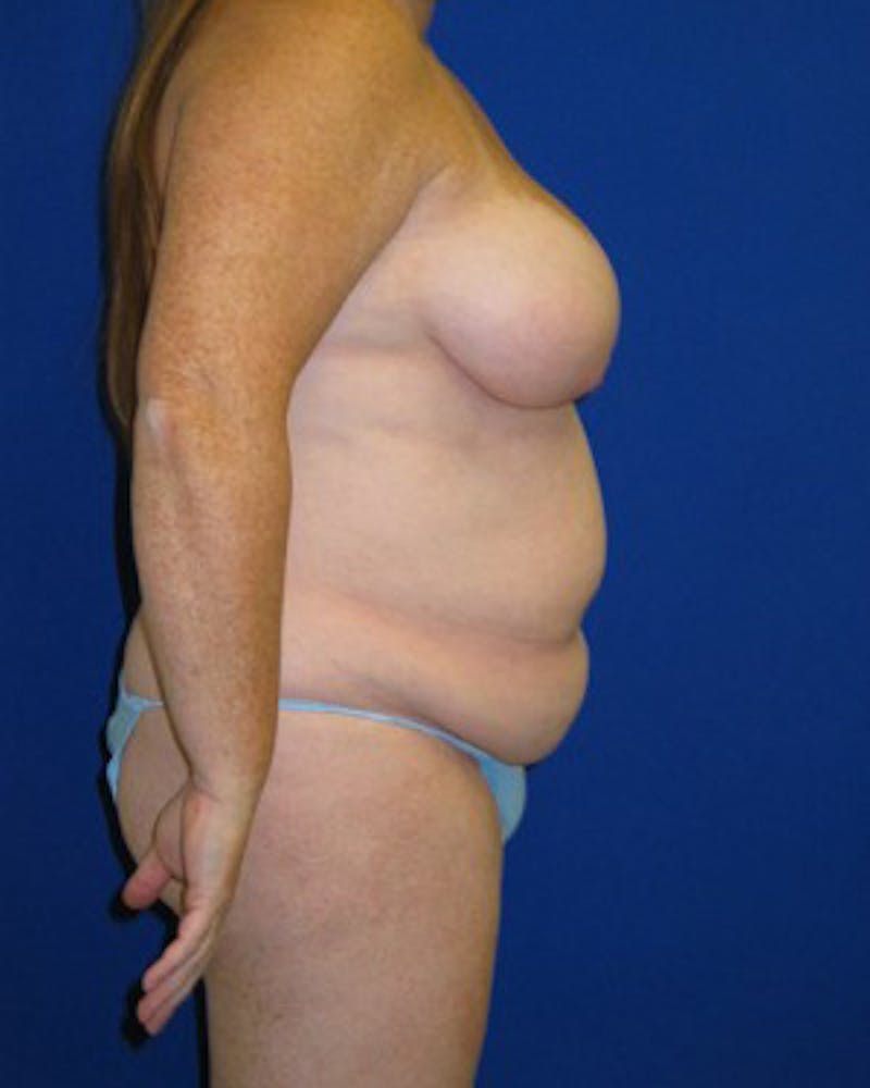 Mommy Makeover Before & After Gallery - Patient 175169121 - Image 3