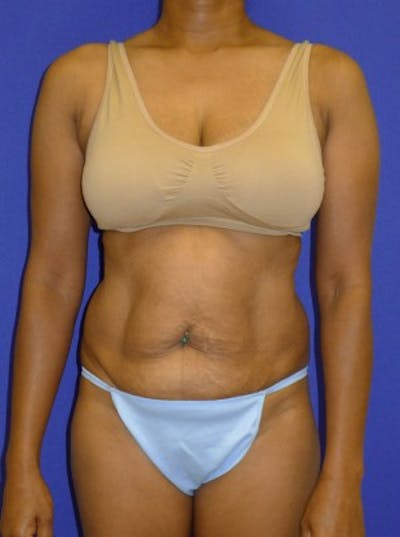 Mommy Makeover Before & After Gallery - Patient 175169133 - Image 1