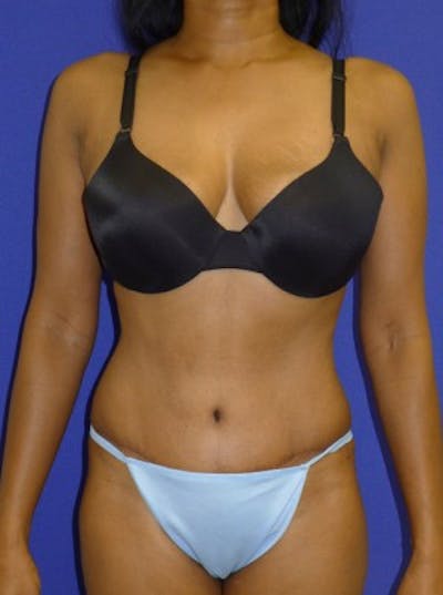 Mommy Makeover Before & After Gallery - Patient 175169133 - Image 2