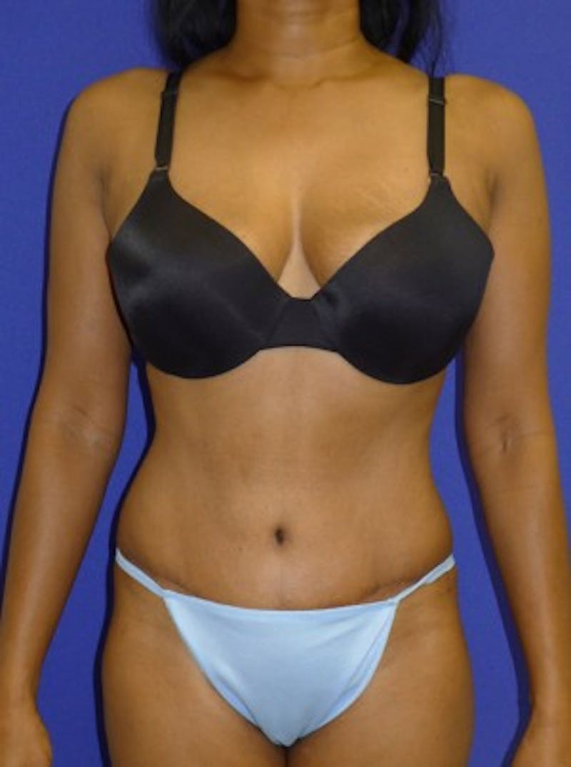Mommy Makeover Before & After Gallery - Patient 175169133 - Image 2