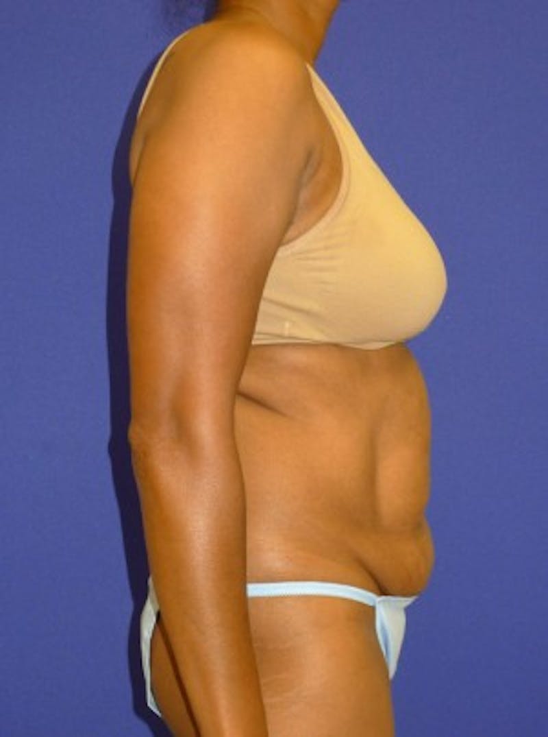 Mommy Makeover Before & After Gallery - Patient 175169133 - Image 3