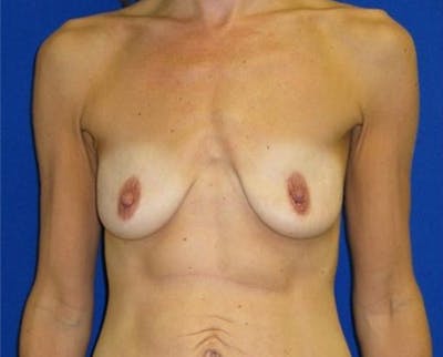 Augmentation Before & After Gallery - Patient 175169148 - Image 1