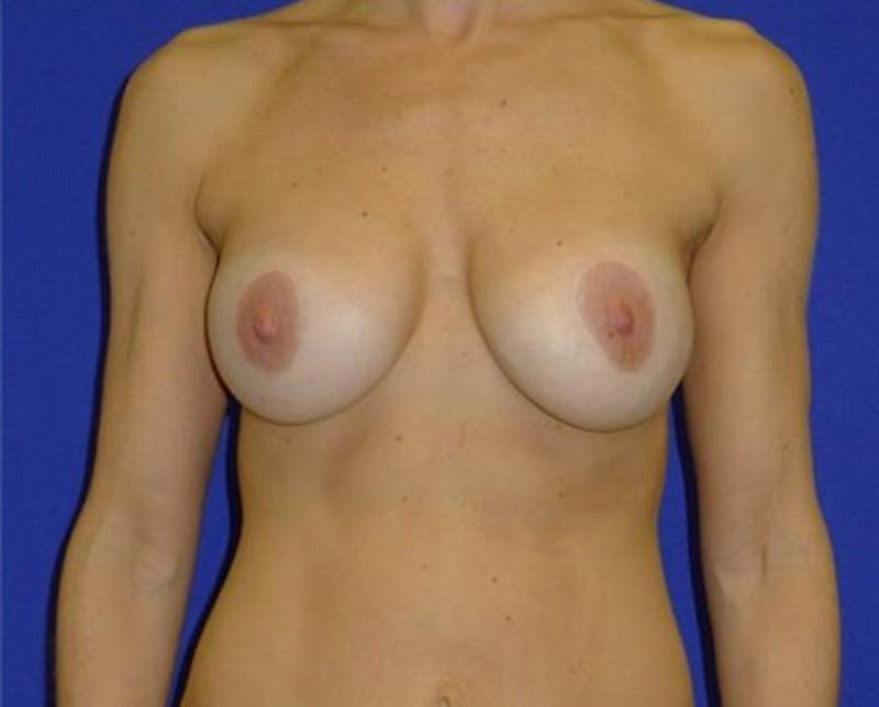 Augmentation Before & After Gallery - Patient 175169148 - Image 2